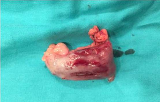 Divertículo de Meckel extirpado.