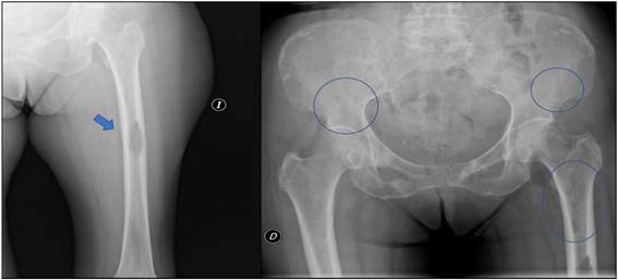 A) Radiografía del fémur izquierdo que muestra una lesión osteolítica de 51 x 22 mm con destrucción de la cortical. B) Radiografía de pelvis en la que se aprecian múltiples lesiones osteolíticas de menor tamaño, ofreciendo una imagen de patrón moteado.