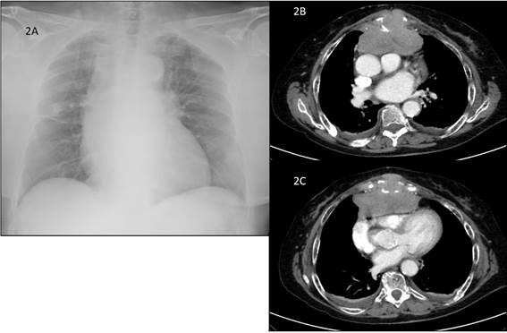 A) Radiografía de tórax que muestra cardiomegalia, ensanchamiento mediastínico y redistribución vascular. B) y C) Tomografía torácica: Lesión lítica ósea en el cuerpo esternal con una gran masa de partes blandas, heterogénea, de 40 x 94 mm, que invade el mediastino anterior. Ejerce efecto masa sobre las cavidades cardiacas derechas que provocaba una dilatación del tronco de la arteria pulmonar, sugiriendo cierto grado de hipertensión pulmonar.
