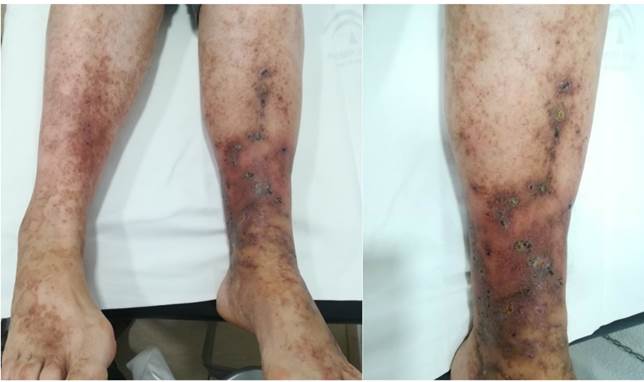 Lesiones en miembros inferiores