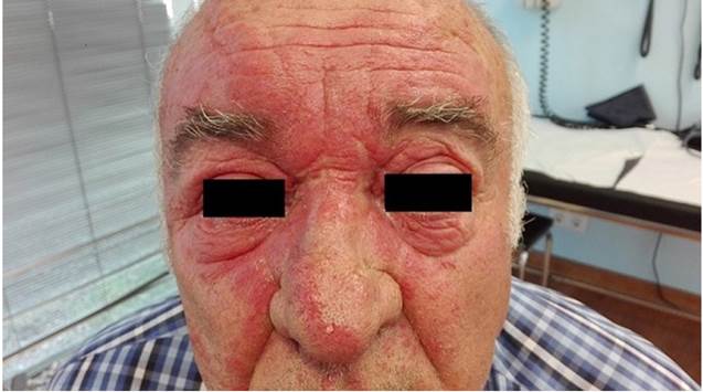 Edema palpebral e inyecci&oacute;n conjuntival.