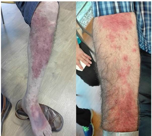 Placas eritemato-viol&aacute;ceas confluentes, con lesiones perif&eacute;ricas de morfolog&iacute;a dianiforme y ves&iacute;culas peque&ntilde;as pretibiales con leve descamaci&oacute;n.