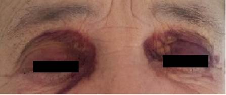 Hematomas periorbitarios