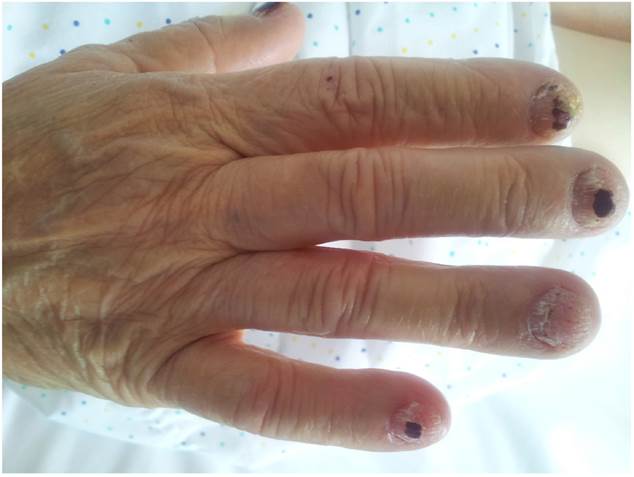 Destrucci&oacute;n de la l&aacute;mina ungueal en los dedos