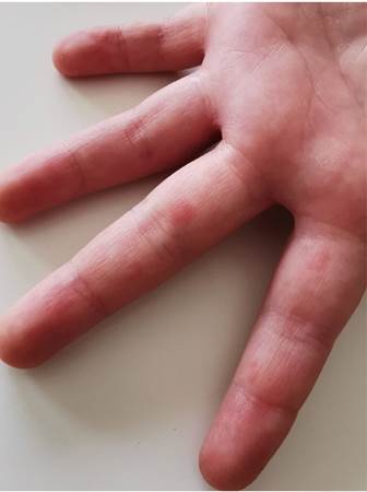 P&aacute;pulas eritematosas en los dedos de la mano.