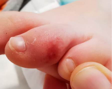 M&aacute;culo-p&aacute;pulas en dedo del pie izquierdo, similar a eritema pernio (saba&ntilde;ones).