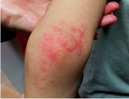 M&aacute;culo-p&aacute;pulas de aspecto discoide sugerente de eritema multiforme.