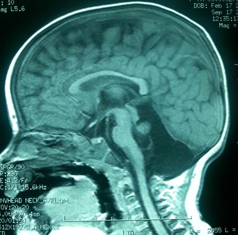 RNM cerebral en corte sagital. Hipoplasia cerebelosa.