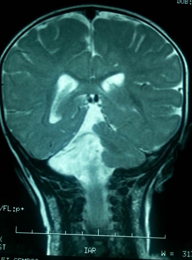 RNM cerebral. Ausencia del vermis y del hemisferio cerebeloso derecho, salvo remanente del pedúnculo cerebeloso medio, así como una disminución marcada del tamaño del hemisferio cerebeloso izquierdo.