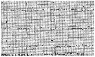Electrocardiograma con ritmo auriculoventricular disociado y QRS ensanchado, compatible con bloqueo aur&iacute;culo-ventricular completo.