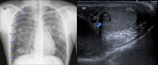A) Radiograf&iacute;a de t&oacute;rax en la que se aprecia un neumot&oacute;rax que afecta al 40 % del pulm&oacute;n derecho (flechas) e imagen en suelta de globos que afecta a ambos pulmones. B) Ecograf&iacute;a testicular donde apreciamos una lesi&oacute;n pseudonodular en el test&iacute;culo izquierdo de 8x9 mm con presencia de microcalcificaciones y vascularizaci&oacute;n intratesticular sugestivo de proceso neoformativo primario.