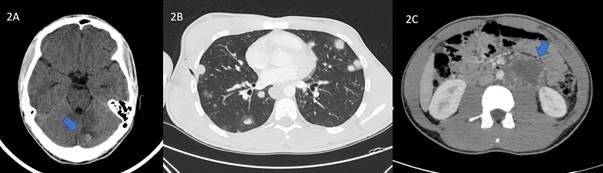 A) TAC craneal donde se objetiva una lesi&oacute;n nodular hiperdensa en la regi&oacute;n occipital izquierda con discreto edema, sin efecto de masa, sugerente de met&aacute;stasis. B) TAC tor&aacute;cico: a nivel del par&eacute;nquima pulmonar se observan m&uacute;ltiples n&oacute;dulos redondeados, s&oacute;lidos y con un ligero halo alrededor que ocupan ambos campos pulmonares, muchos de ellos subpleurales. C) TAC abdominal: a nivel retroperitoneal se identifica una lesi&oacute;n heterog&eacute;nea, predominantemente hipodensa, de bordes lobulados y captaci&oacute;n perif&eacute;rica con &aacute;reas de necrosis en relaci&oacute;n con conglomerado adenop&aacute;tico.