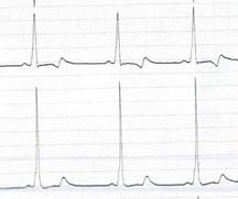 Onda delta característica con intervalo PR corto, que refleja preexcitación.