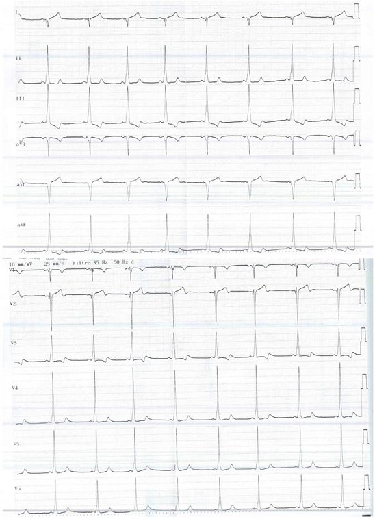 Electrocardiograma del paciente donde se objetiva un PR corto con una onda delta positiva en la cara inferior, negativa en I y aVF y derivaciones precordiales.