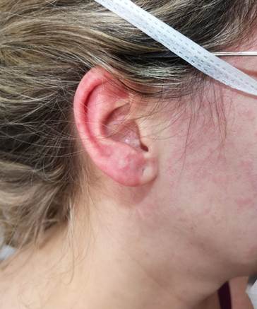 Lesiones maculosas en la regi&oacute;n facial.