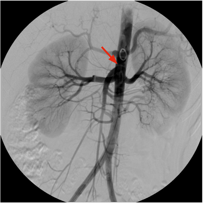 Aortografía abdominal y renal en las que se evidencian ambas arterias renales normales y una estenosis de la vena izquierda condicionada por una pinza aortomesentérica.