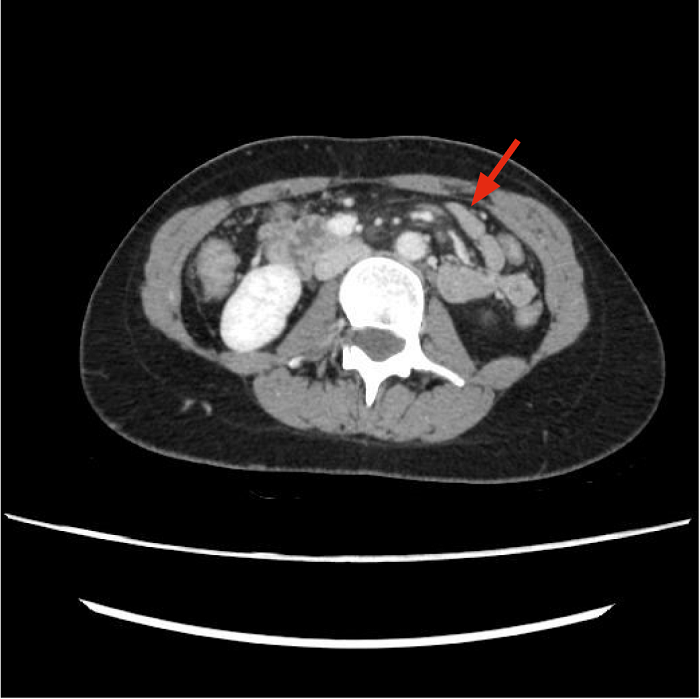 TC abdominal en la que se objetiva un stent en la vena renal izquierda.