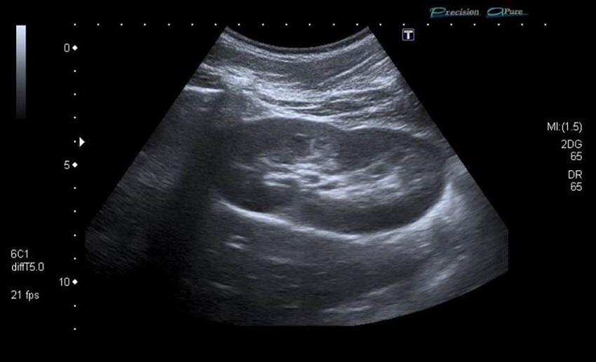 Riñón único derecho, no claramente compensador.