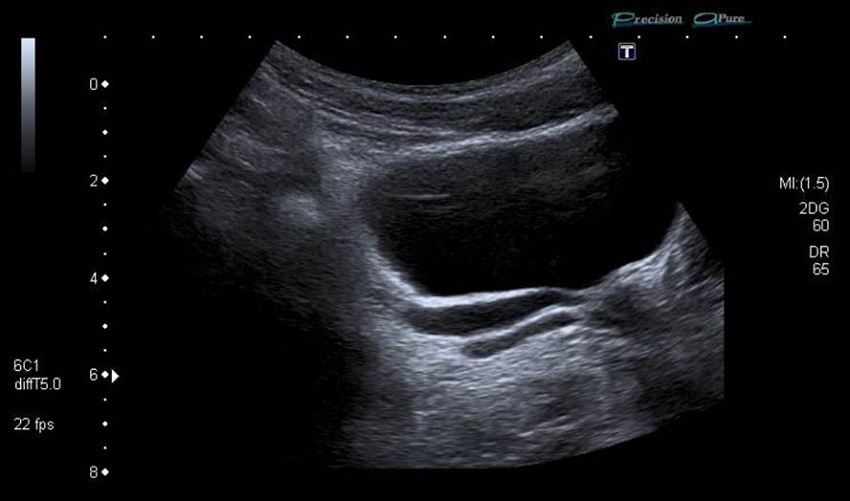 Dos imágenes quísticas retrovesicales izquierdas, alargadas, que parecen desembocar en la próstata o el cuello vesical.