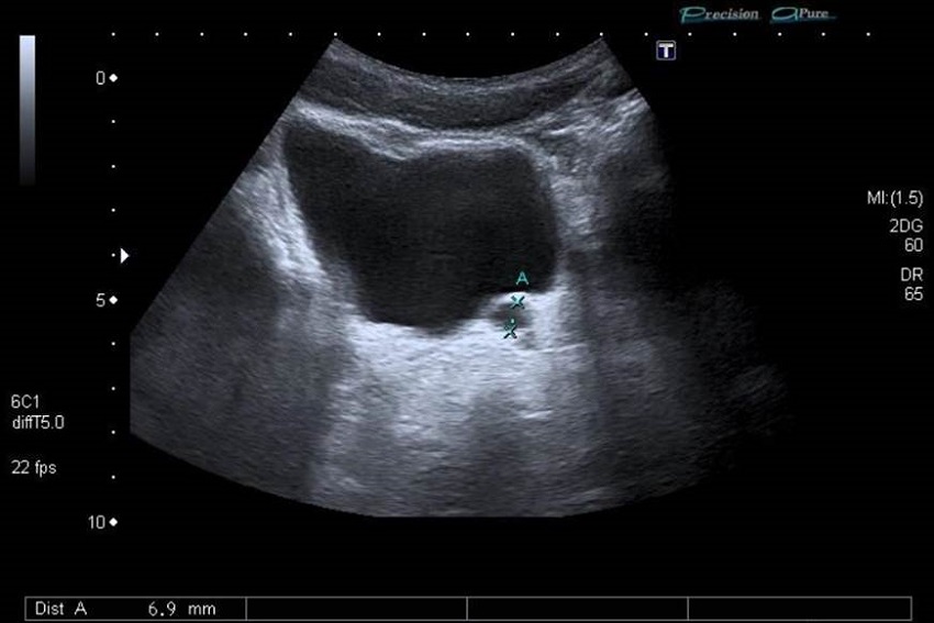 Dilatación de la vesícula seminal o del quiste mesofrénico.