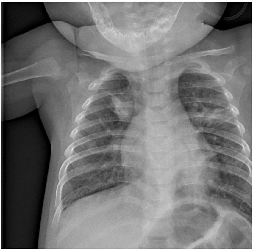 Consolidaciones segmentarias bilaterales retrocardíacas en lóbulos superiores. Leves engrosamientos peribronquiales difusos.