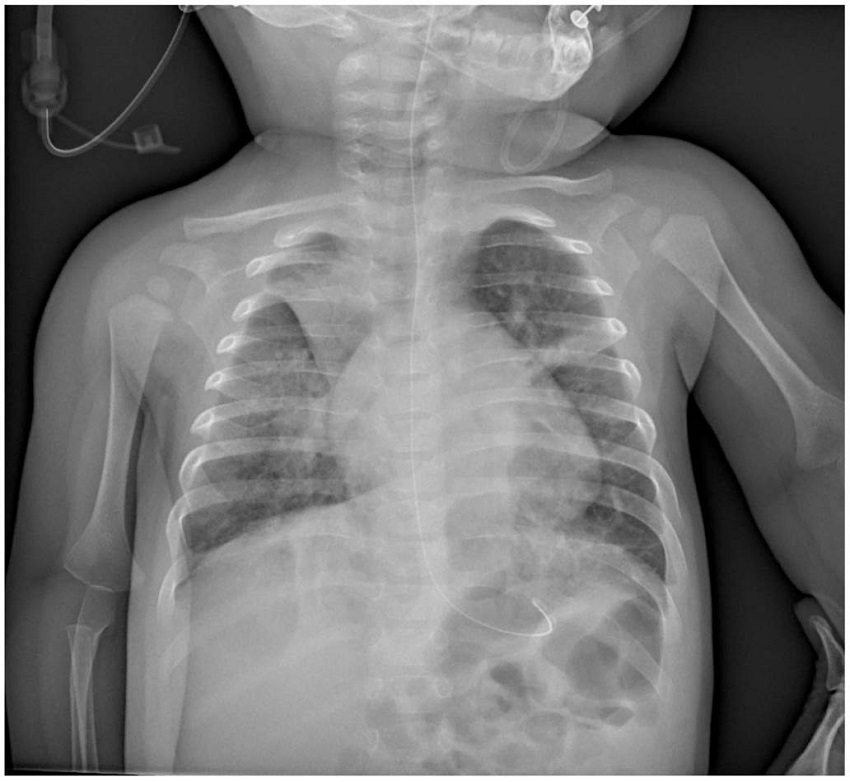 Atelectasia del lóbulo superior derecho. Consolidación retrocardíaca similar. Mejoría de la consolidación segmentaria del lóbulo superior izquierdo. Persisten engrosamientos peribronquiales difusos bilaterales, más evidentes en el pulmón derecho por la pérdida de volumen.