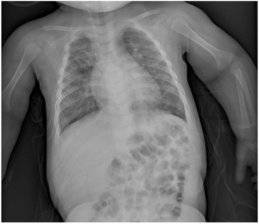 Persistencia de los engrosamientos peribronquiales y ligero aumento difuso de la densidad pulmonar en vidrio deslustrado. Mejoría de las consolidaciones retrocardíacas del lóbulo superior derecho y el lóbulo inferior izquierdo.