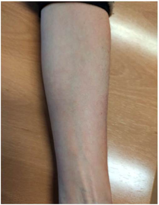 Lesión a los 60 días de tratamiento tópico con fluticasona 0,5 mg en crema y gel de silicona.