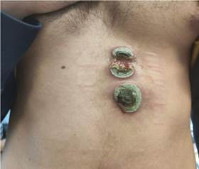 Heridas en pared abdominal al inicio del seguimiento