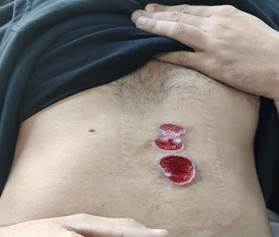 Heridas tras la desbridaci&oacute;n quir&uacute;rgica