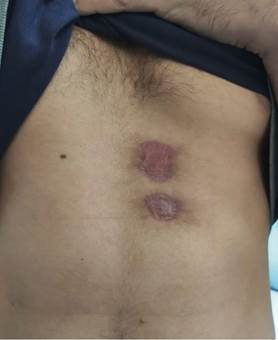 Evoluci&oacute;n de las heridas tras 10 d&iacute;as de curas