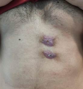 Cicatrices hipertr&oacute;ficas sobre las lesiones iniciales