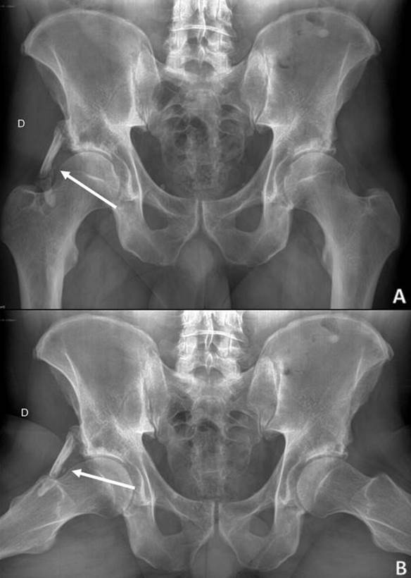 Radiograf&iacute;a simple de cadera en proyecciones anteroposterior (A) y axial (B)