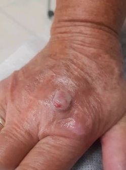 Visi&oacute;n frontal. Lesi&oacute;n nodular en dorso de la mano
