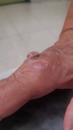 Visi&oacute;n lateral. Lesi&oacute;n nodular sobreelevada con bordes erosionados