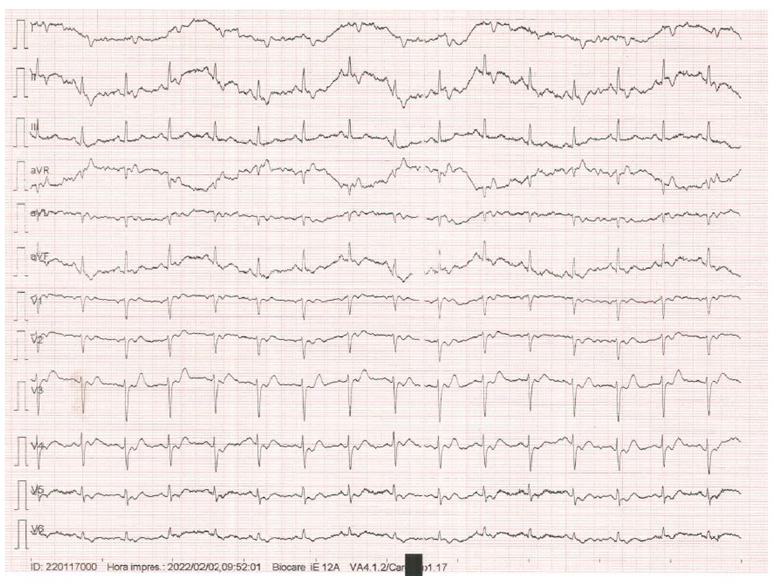 Electrocardiograma inicial realizado en el centro de salud. Se aprecia taquicardia sinusal a 100 latidos por minuto, desviado hacia la derecha. Infradesnivelaci&oacute;n del segmento ST de V2 a V5. Inversi&oacute;n de la onda T en las derivaciones I, II, aVF, V1, V2, V5 y V6