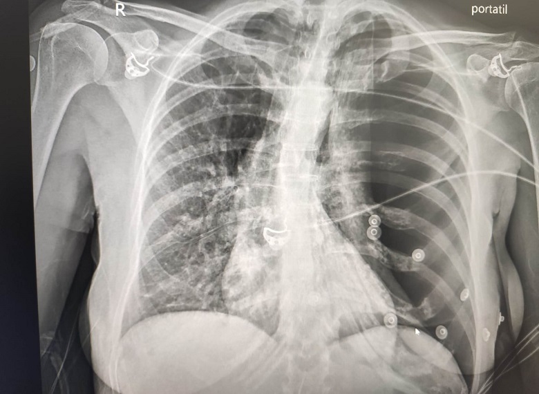 Radiograf&iacute;a anteroposterior de t&oacute;rax de la paciente a su llegada a urgencias. Se aprecia neumot&oacute;rax izquierdo a tensi&oacute;n masivo con desplazamiento de la v&iacute;a a&eacute;rea contralateral