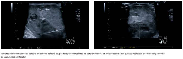 Ecograf&iacute;a testicular: tumoraci&oacute;n s&oacute;lida en test&iacute;culo derecho