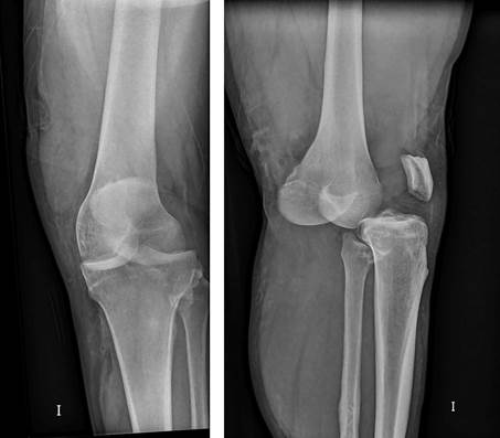 Proyecci&oacute;n anteroposterior y lateral de la rodilla izquierda donde se aprecia una luxaci&oacute;n anterior femorotibial, sin aparentes lesiones &oacute;seas asociadas