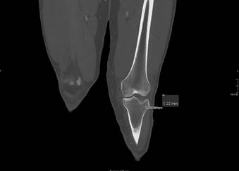 Angio-TC de rodilla izquierda donde se aprecia una fractura hundimiento de la cara anterior de la meseta tibial externa de 7 mm