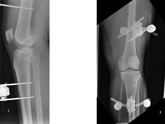 Proyecci&oacute;n anteroposterior y lateral de la rodilla izquierda una vez reducida la luxaci&oacute;n femorotibial anterior e inmovilizada con fijador externo