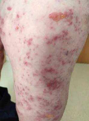 Lesiones papulosas violáceas en miembro inferior.