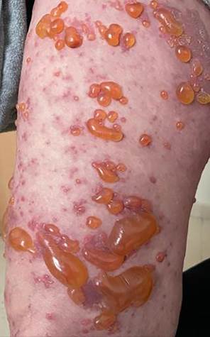 Ampollas tensas en miembro inferior.