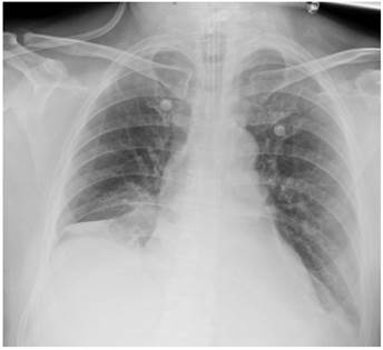 Radiografa de trax donde destaca imagen de densidad de agua de aspecto circular y bordes bien delimitados en zona parahiliar derecha