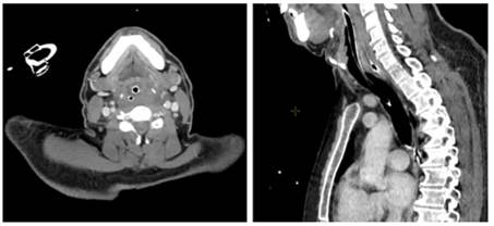 Tomografa computarizada cervical y torcica donde se ve lquido en el espacio visceral izquierdo del cuello, que se extiende focalmente hacia el espacio retrofarngeo, sin llegar a sobrepasar la altura del hioides. Se observa tubo orotraqueal