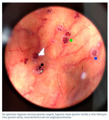 Vista dermatosc�pica de angioqueratomas de Fordyce