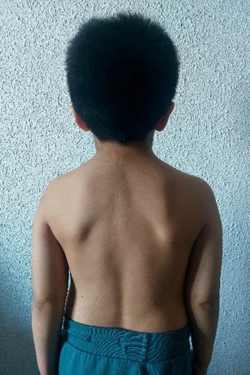 Fotograf�a del paciente a los 6 a�os. Se puede observar una ligera macrocefalia, medida del per�metro cef�lico 54,5 cm correspondiente a un percentil 98