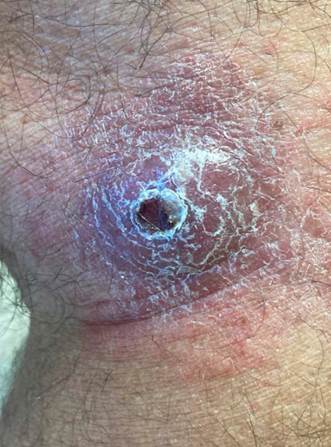 Lesi�n en cara externa rodilla al inicio del cuadro