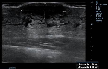 Ecograf�a de partes blandas de la lesi�n. Lesi�n hipoecoica de 1,98 x 0,7 sin restos de detritus