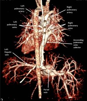 A Multislice computer tomography with contrast agent 3D reconstruction All the pulmonary veins had gathered into a common collector and had joined the portal vein The collector narrowed to 25 mm at the place of the connection
